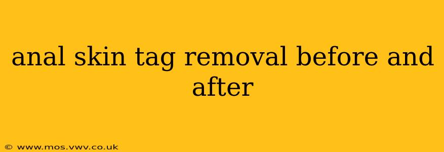 anal skin tag removal before and after