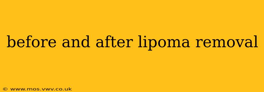 before and after lipoma removal