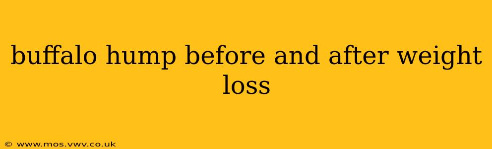buffalo hump before and after weight loss