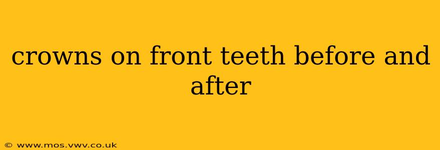 crowns on front teeth before and after