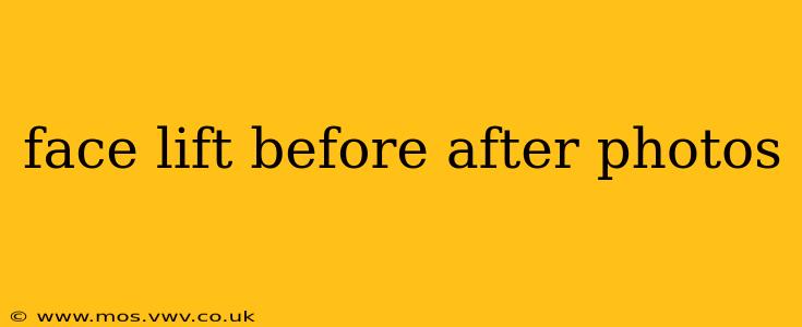 face lift before after photos