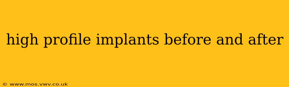 high profile implants before and after