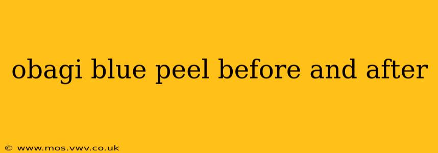 obagi blue peel before and after