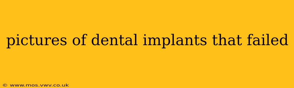 pictures of dental implants that failed