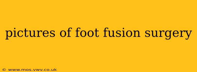 pictures of foot fusion surgery