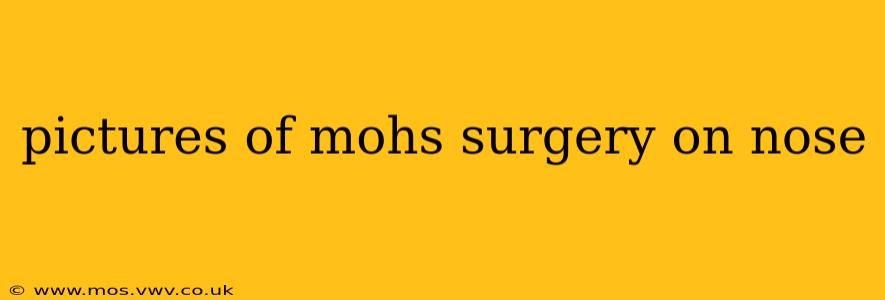 pictures of mohs surgery on nose