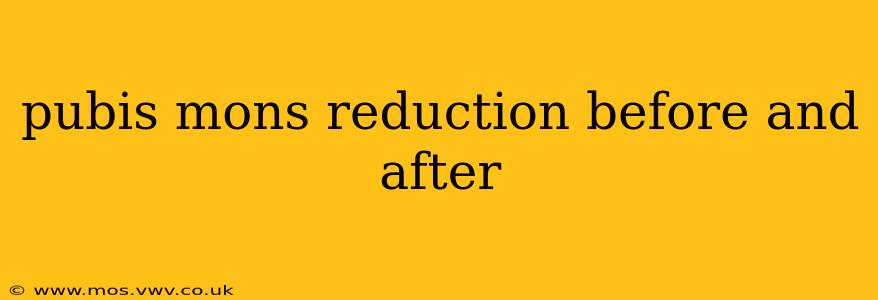 pubis mons reduction before and after