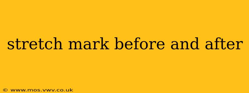 stretch mark before and after