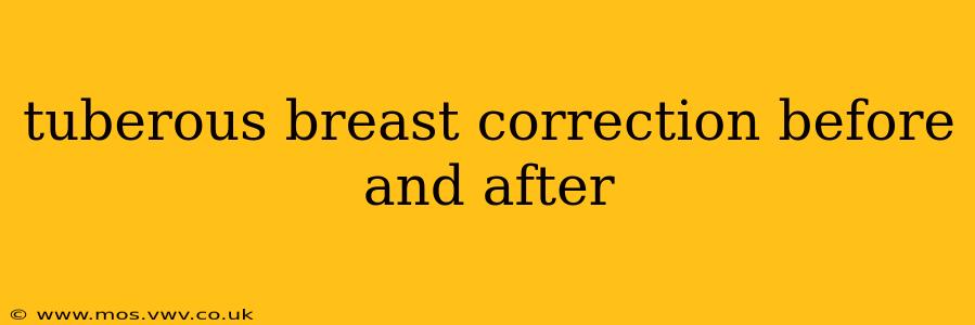 tuberous breast correction before and after