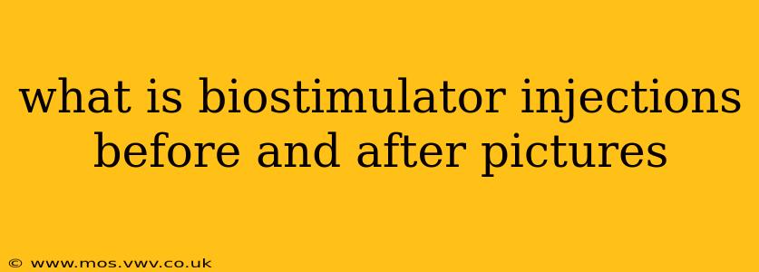 what is biostimulator injections before and after pictures